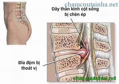 thoat-vi-dia-dem-dung-thuoc-gi