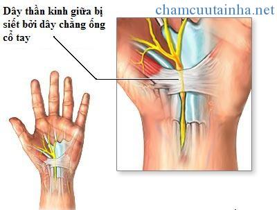 xoa-bop-chua-hoi-chung-ong-co-tay