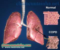 copd-2