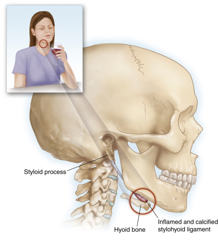 Hội chứng xương móng: Điều trị bằng châm cứu